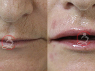 Radiofrekventno pomlađivanje lica frakcijiskim sublativom Syneron 1