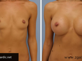 Povećanje grudi 28