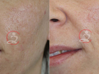 Radiofrekventno pomlađivanje lica frakcijiskim sublativom Syneron 2