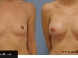 Povećanje grudi 29
