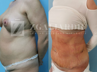Lipoabdominoplastika- zatezanje viseće kože trbuha 6