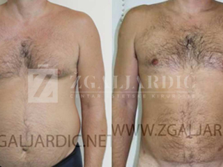 Kirurško tretiranje ginekomastije 11