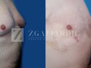 Kirurško tretiranje ginekomastije 15