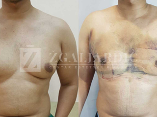 Kirurško tretiranje ginekomastije 9