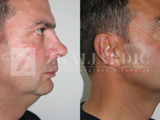 Korekcija podbratka 2