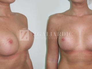 Povećanje grudi 11