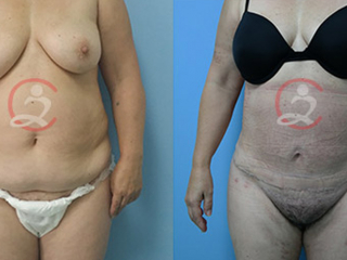 Lipoabdominoplastika- zatezanje viseće kože trbuha 2