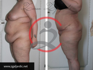 Lipoabdominoplastika- zatezanje viseće kože trbuha 3