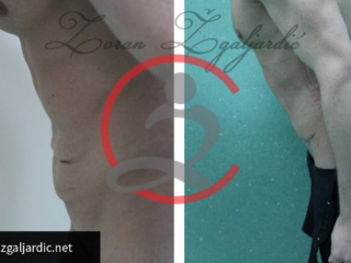 Lipoabdominoplastika- zatezanje viseće kože trbuha 4