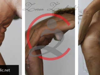 Lipoabdominoplastika- zatezanje viseće kože trbuha 5