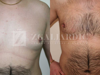 Kirurško tretiranje ginekomastije 7