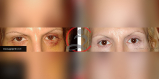Blefaroplastika 2