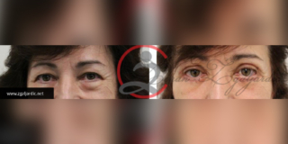 Blefaroplastika 3
