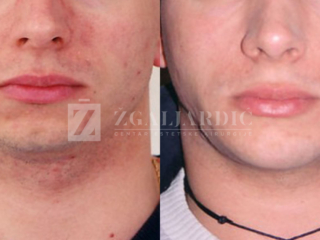 Korekcija brade implantatom 1