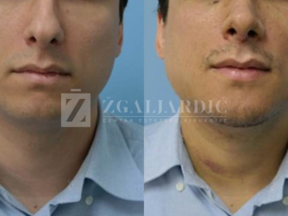 Korekcija brade ostetotomijom i koštanim transplantatom 2