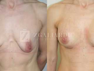 Povećanje grudi 07