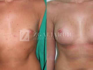 Povećanje grudi 05