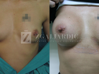Povećanje grudi 04
