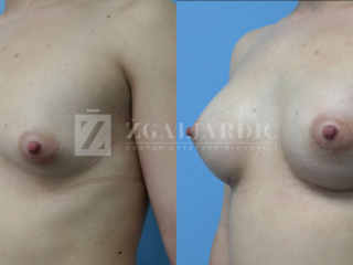 Povećanje grudi 03