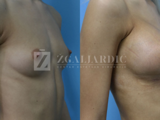 Povećanje grudi 06