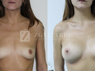 Povećanje grudi 35