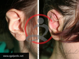 Korekcija ušiju 4