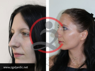 Rinoplastika 11