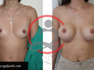 Povećanje grudi 18