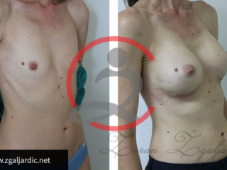 Povećanje grudi 19