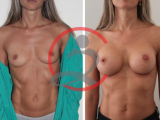 Povećanje grudi 22