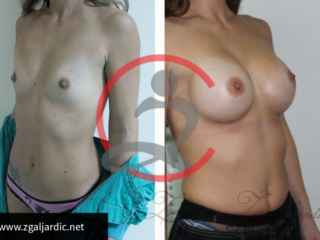 Povećanje grudi 23