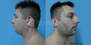 Korekcija podbratka 1