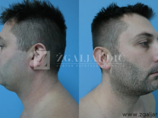 Korekcija podbratka 1