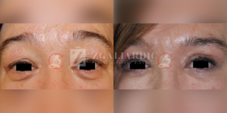 Blefaroplastika 4
