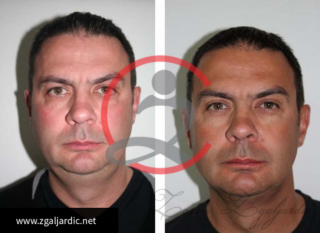 Korekcija podbratka 2