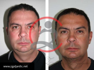 Korekcija podbratka 2