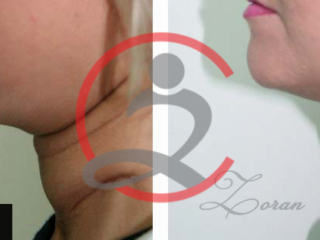 Korekcija podbratka 3