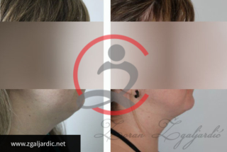 Korekcija podbratka 4