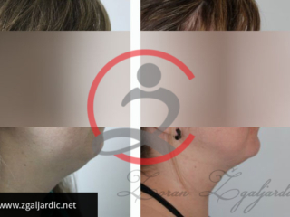 Korekcija podbratka 4