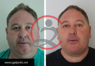 Korekcija podbratka 5