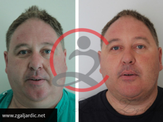 Korekcija podbratka 5