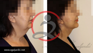 Korekcija podbratka 6