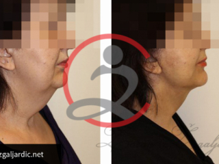 Korekcija podbratka 6