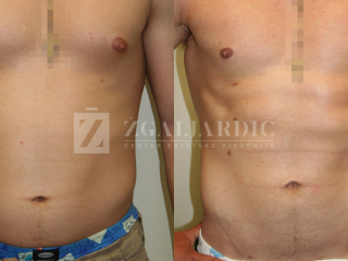 High definition liposukcija