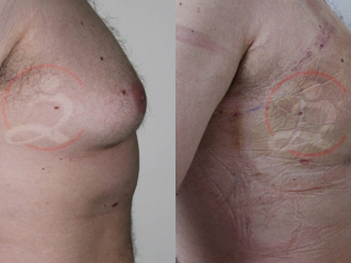 Kirurško tretiranje ginekomastije 10