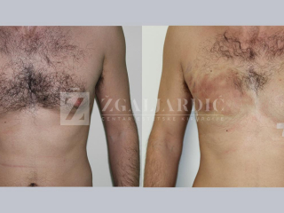 Kirurško tretiranje ginekomastije 6