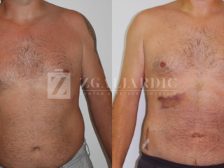 Kirurško tretiranje ginekomastije 1