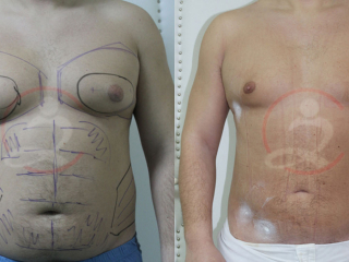 Kirurško tretiranje ginekomastije 4