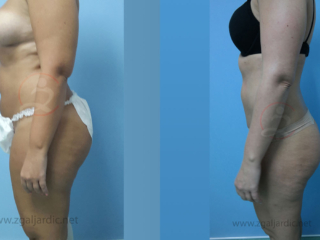 Liposukcija 5