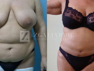 Lipoabdominoplastika- zatezanje viseće kože trbuha 1